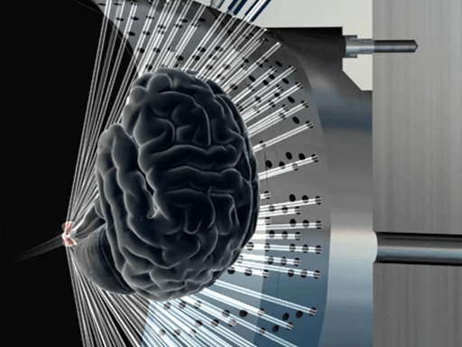 Step 4: Gamma Knife Treatment 